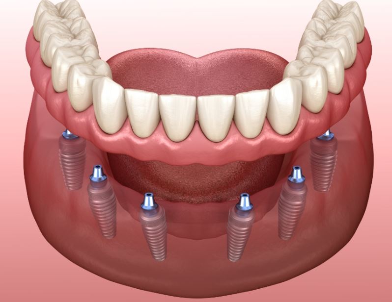 Implant overdenture