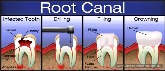 Root Canal