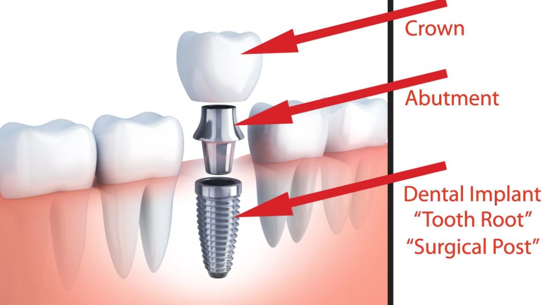 Single Tooth Implant