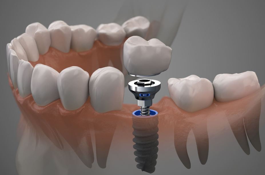 Single Tooth Implant