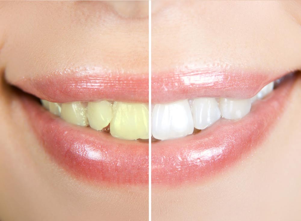 Teeth Whitening